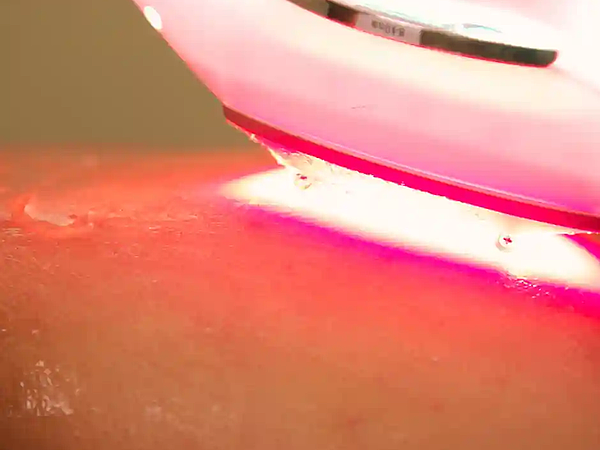 From Pain to Performance: How Class IV Laser Therapy Transforms Recovery
