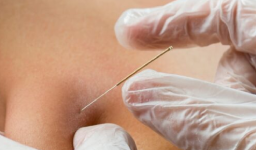 Dry Needling