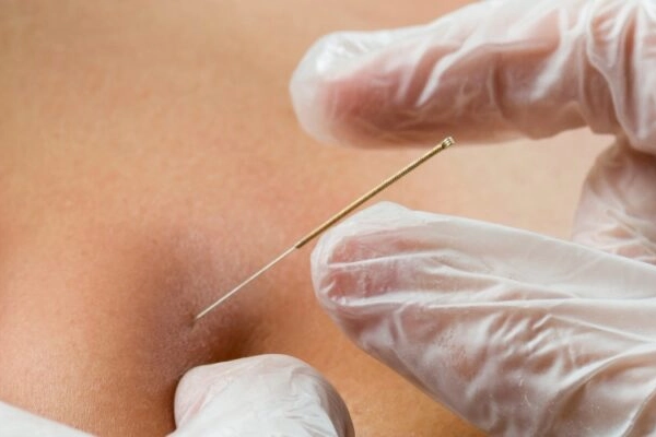 Dry Needling