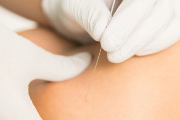 Dry Needling
